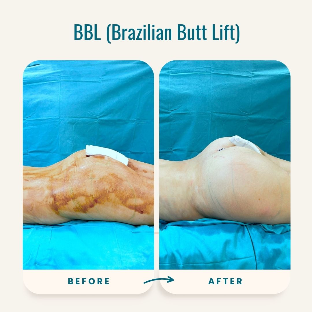 BBL- Brazilian Butt Lift Before-After-3