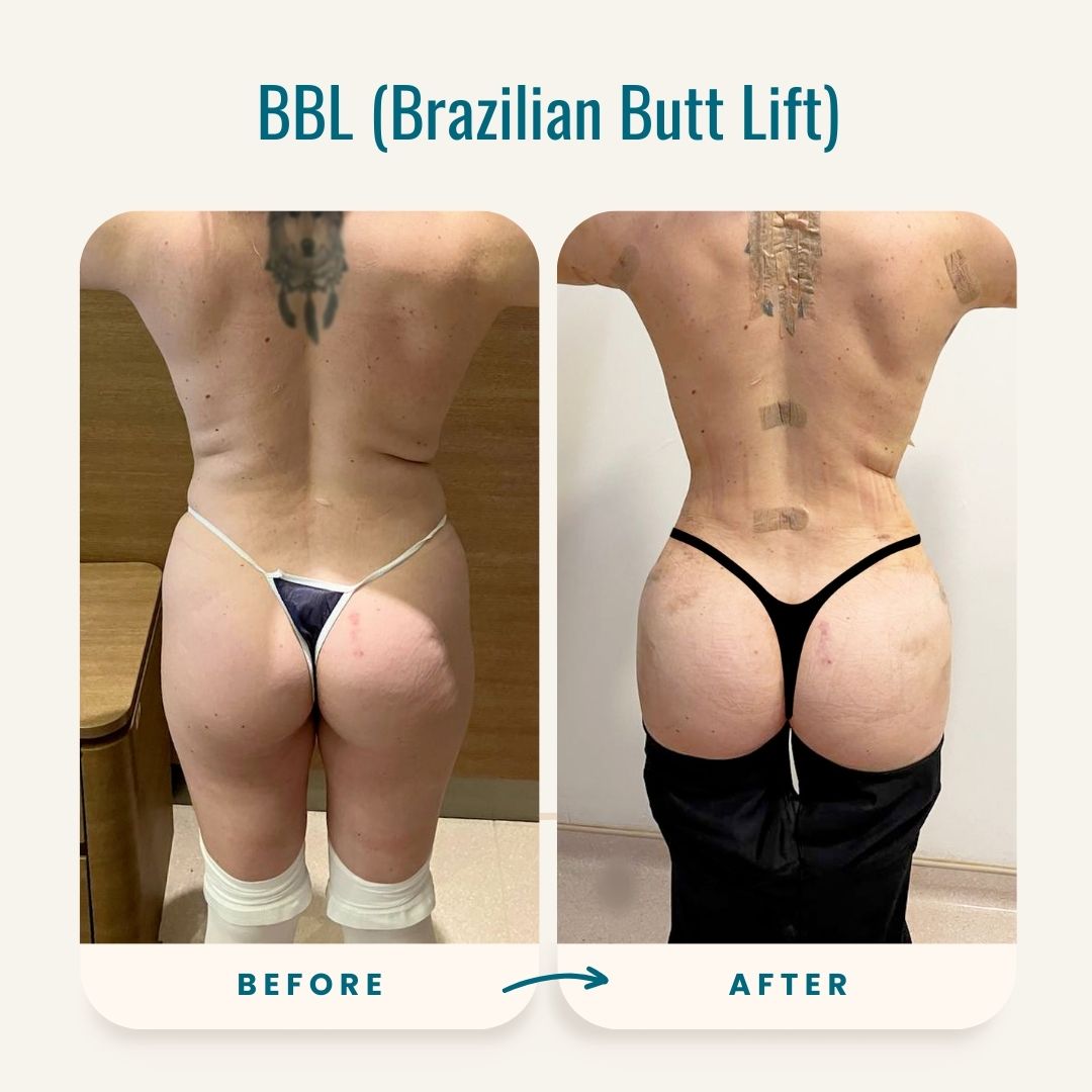 BBL- Brazilian Butt Lift Before-After-4