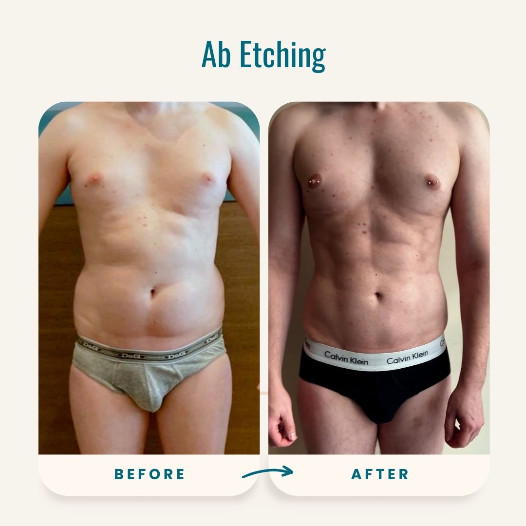 Ab Etching before-after-1