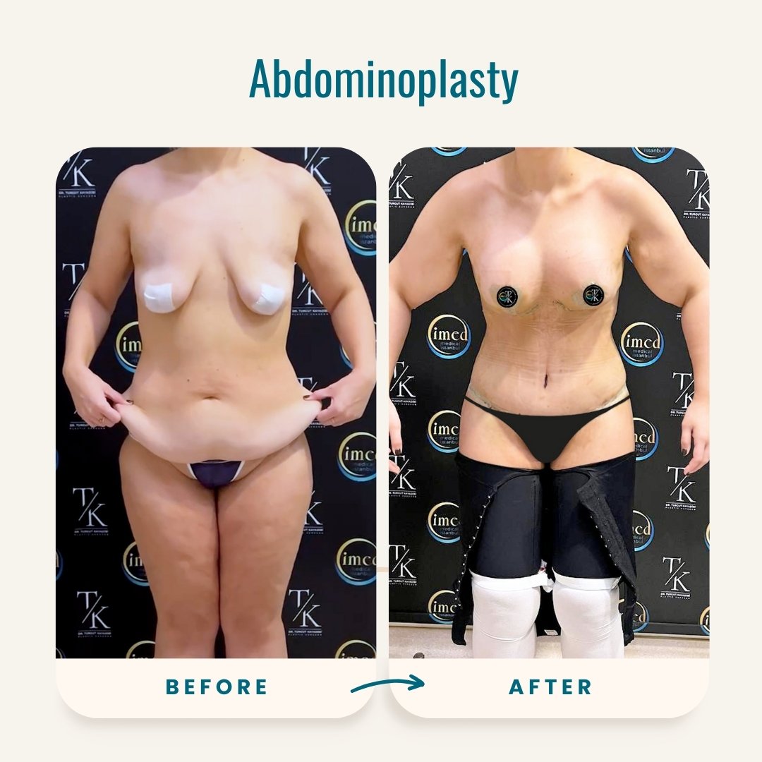 Abdominoplasty (Tummy tuck) before after image-1