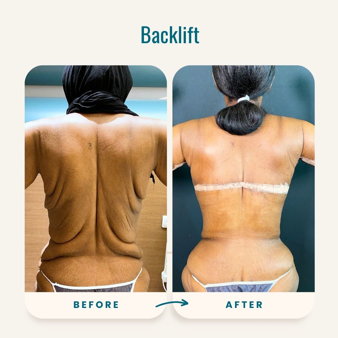 Backlift before-after-1