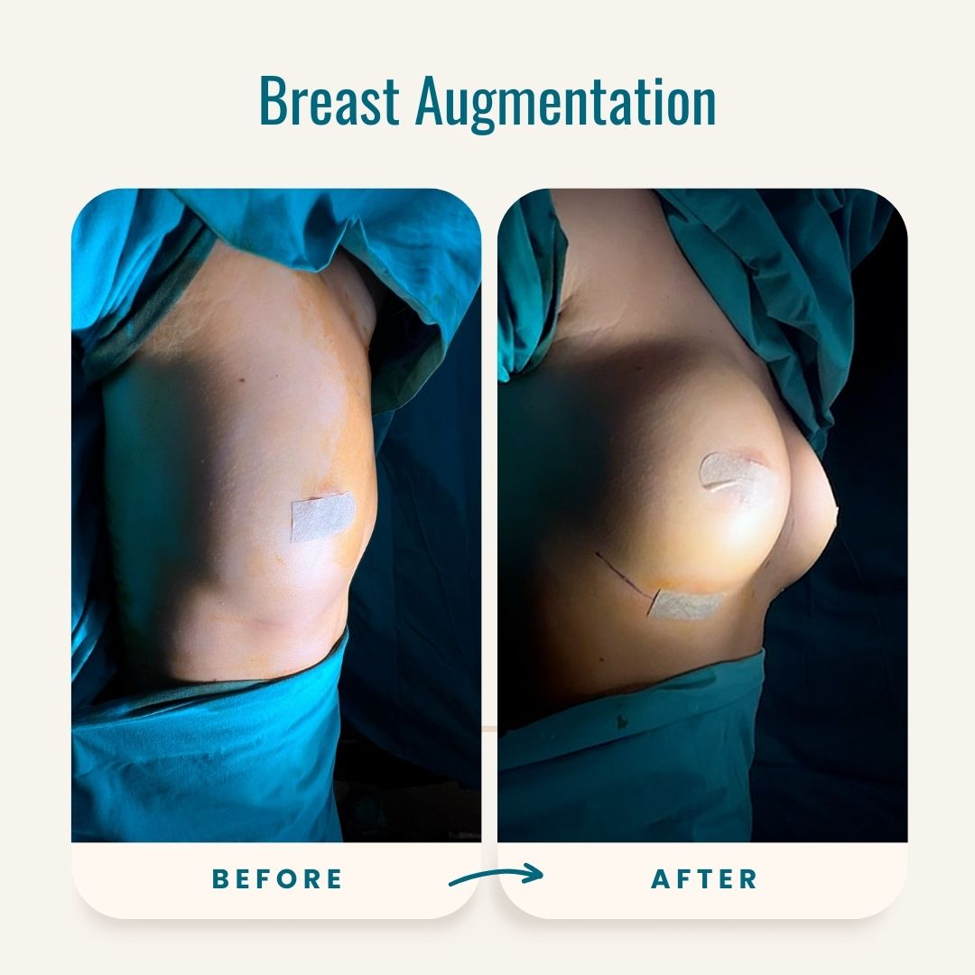 Breast Augmentation before-after-1