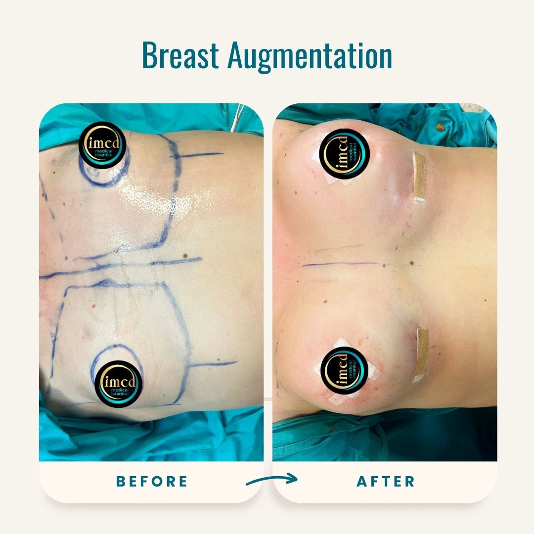 Breast Augmentation before-after-2