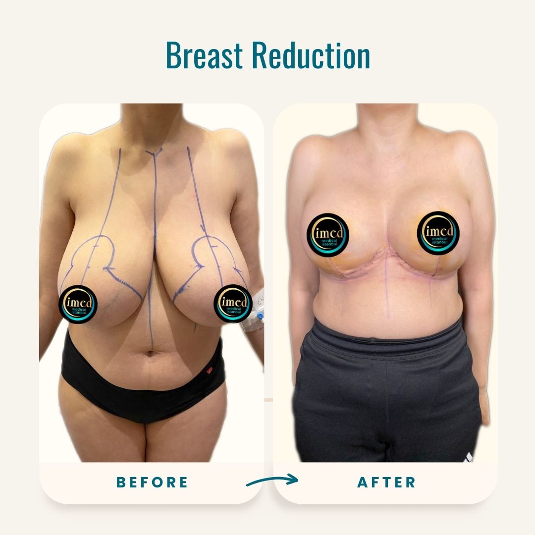 Breast Reduction before-after-2