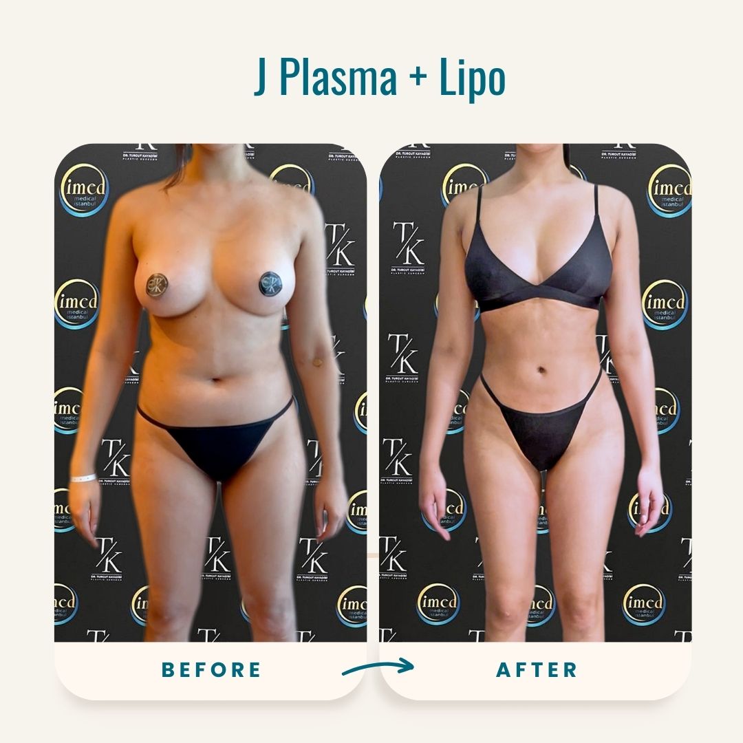 liposuction new york