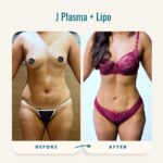 J Plasma + Lipo before-after-2