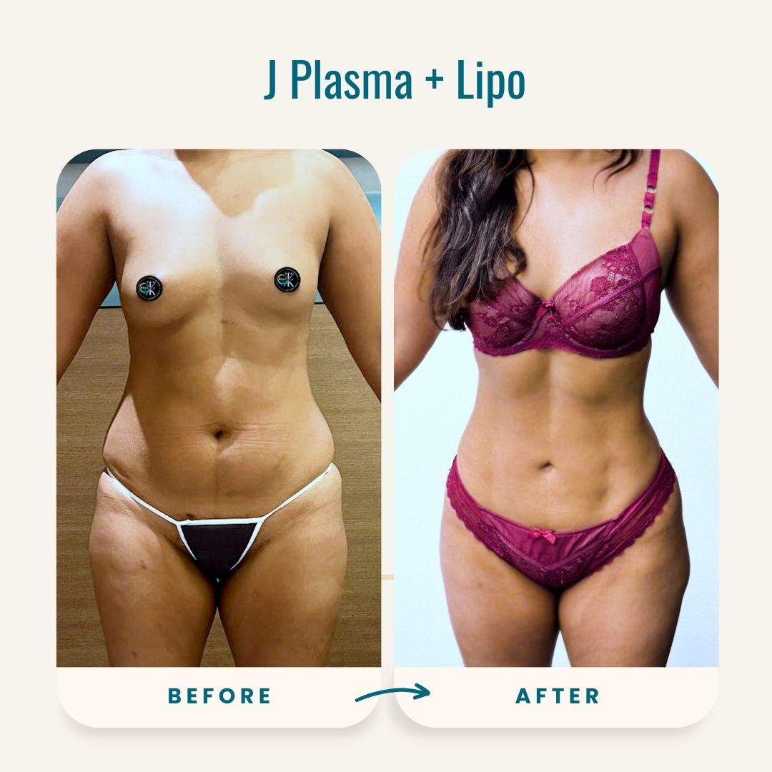 J Plasma + Lipo before-after-2