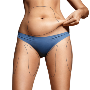 Liposuction