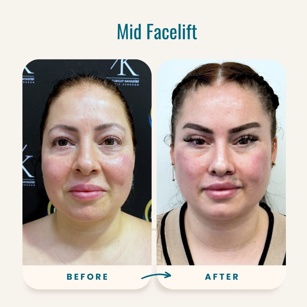 Mid Facelift before-after-1