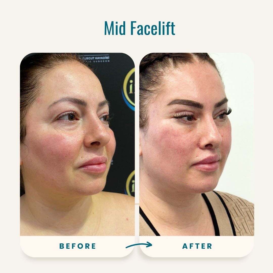 Mid Facelift before-after-2