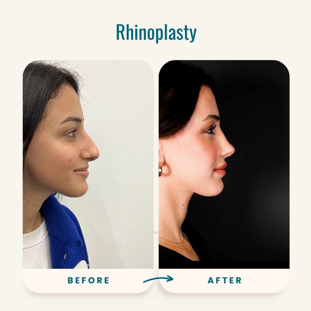 Rhinoplasty before-after-5