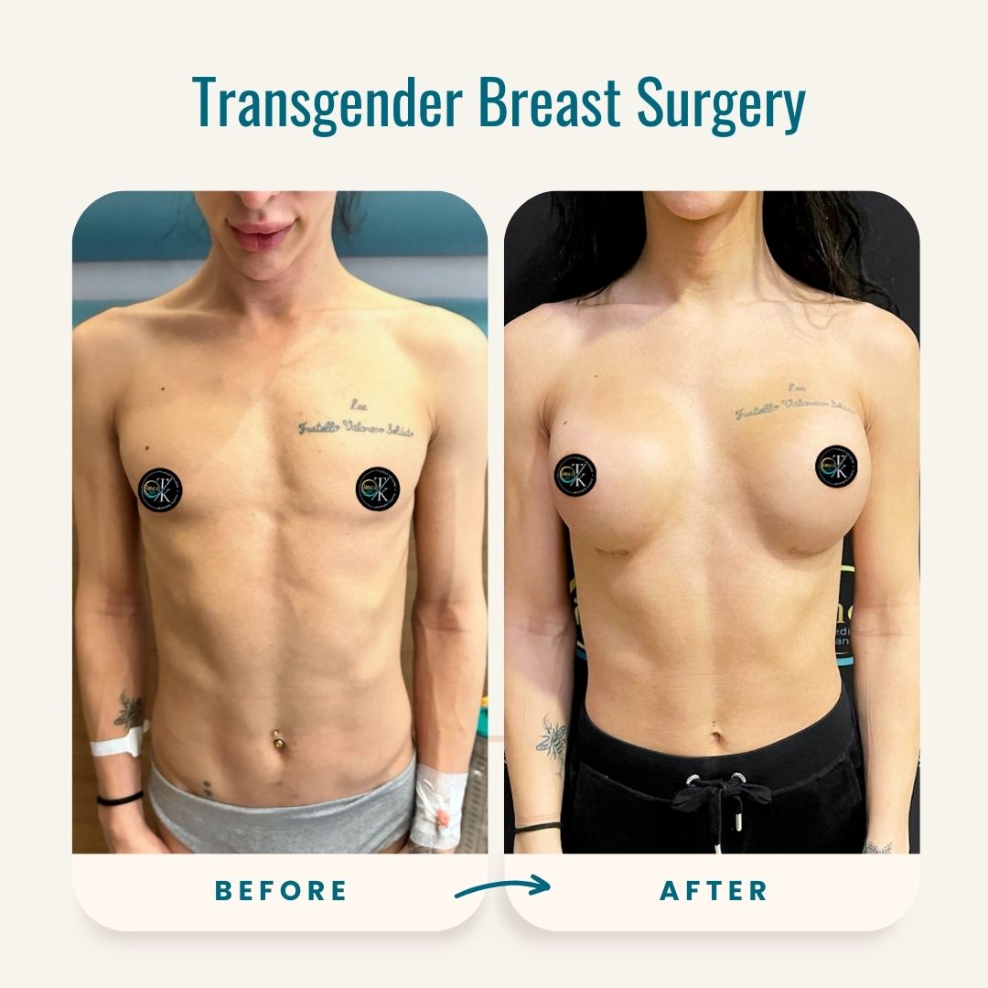 Transgender Breast Surgery before-after-1