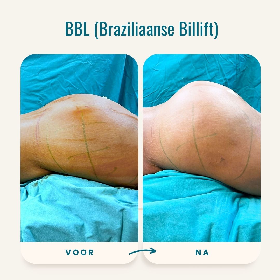 Braziliaanse billift (BBL) voor-na fotos-1