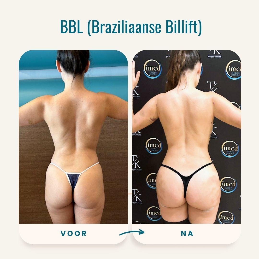 Braziliaanse billift (BBL) voor-na fotos-2