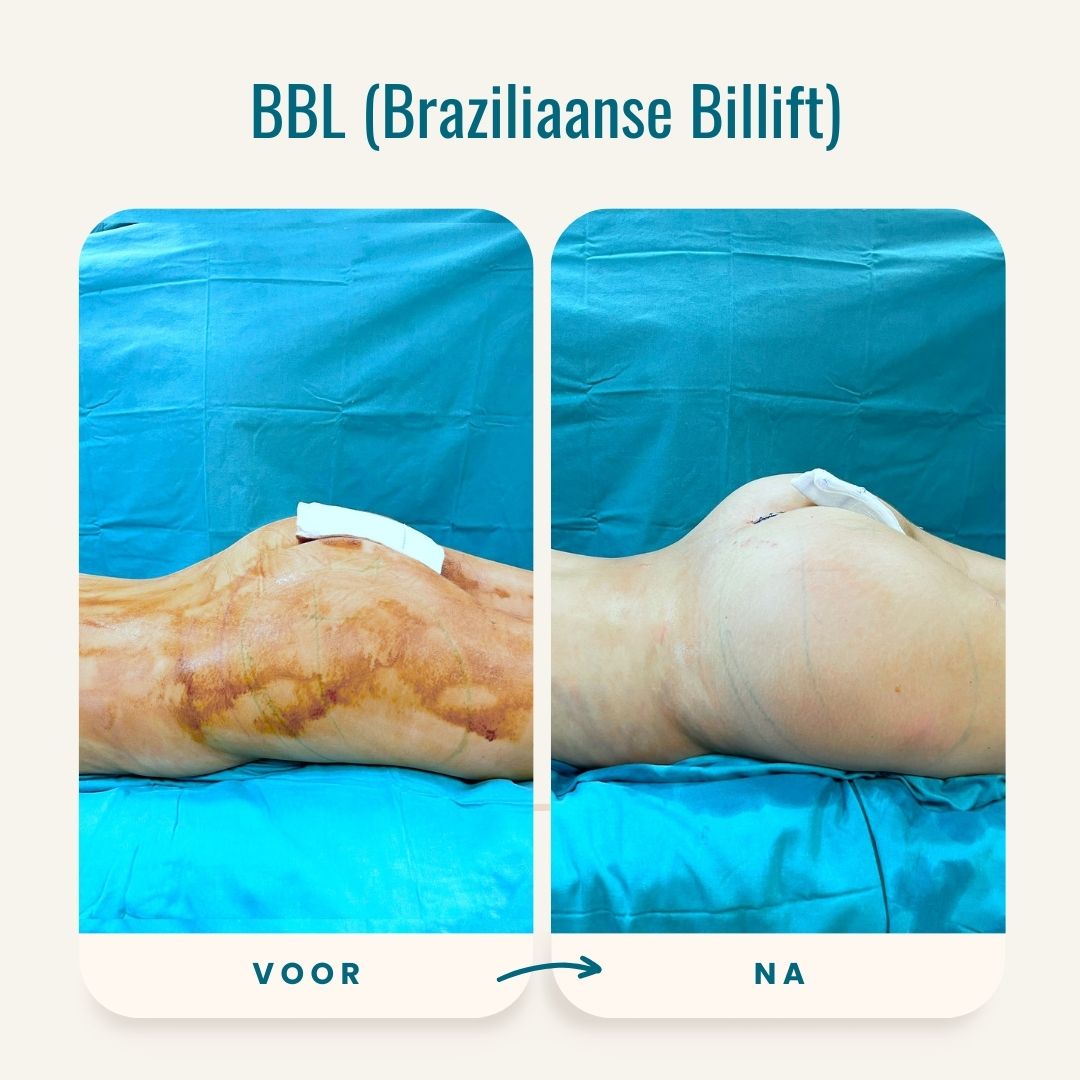 Braziliaanse billift (BBL) voor-na fotos-3