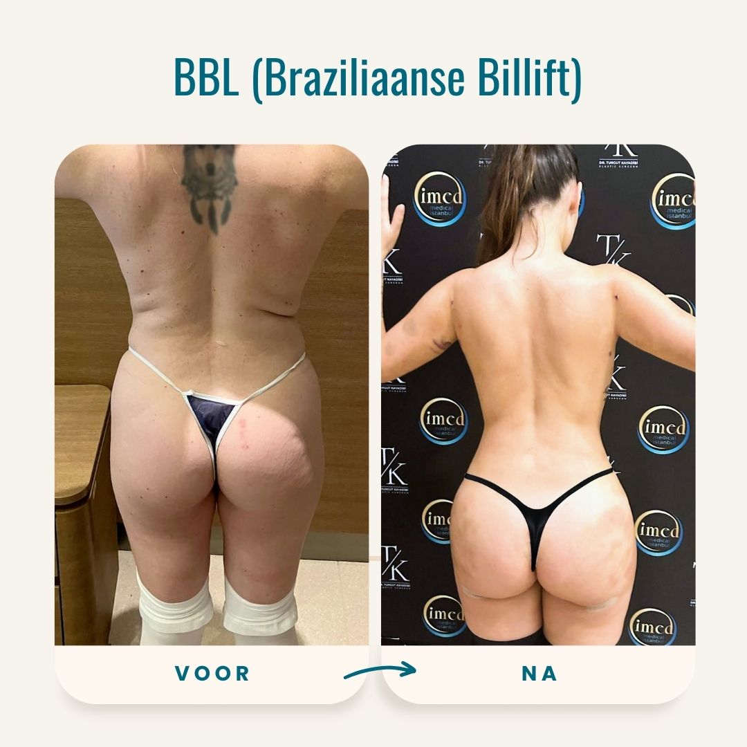 Braziliaanse billift (BBL) voor-na fotos-4