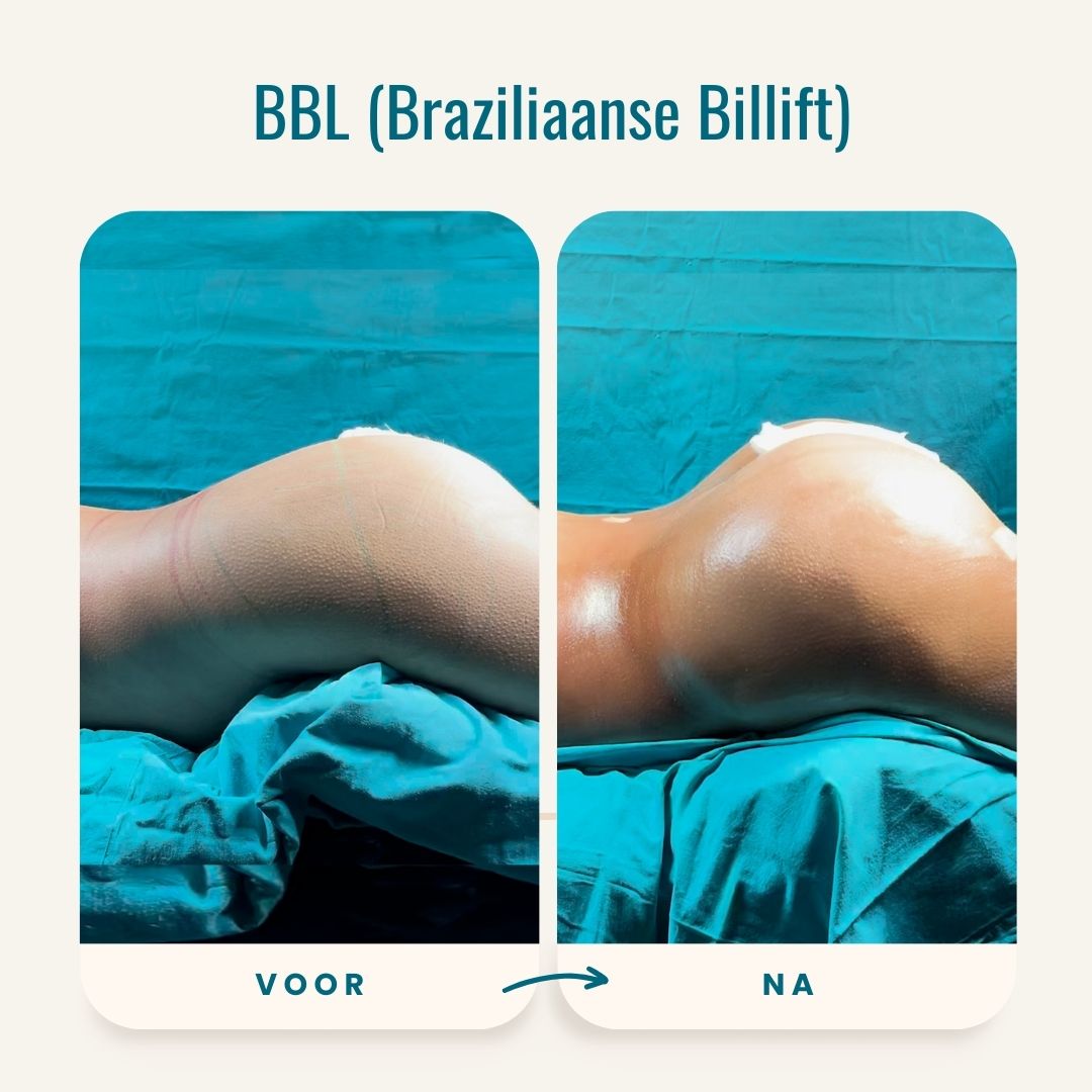 Braziliaanse billift (BBL) voor-na fotos-5