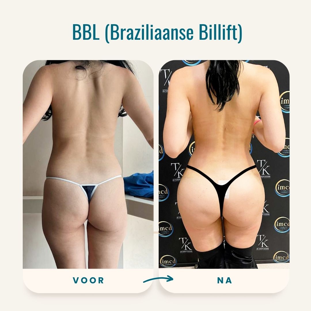 Braziliaanse billift (BBL) voor-na fotos-6