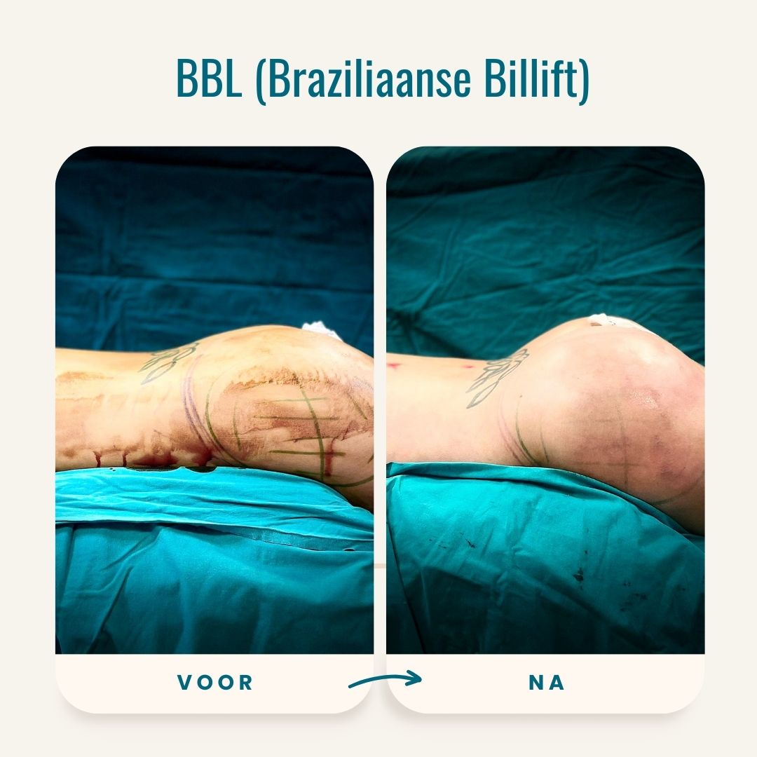 Braziliaanse billift (BBL) voor-na fotos-7