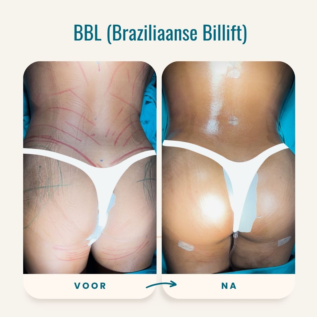 Braziliaanse billift (BBL) voor-na fotos-8