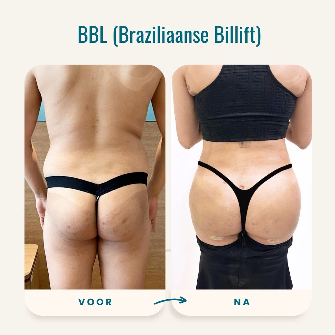 Braziliaanse billift (BBL) voor-na fotos-9