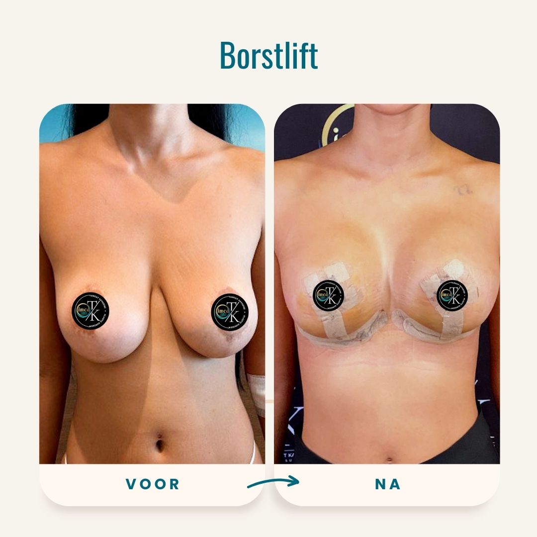 Borstlift voor-na foto's-1