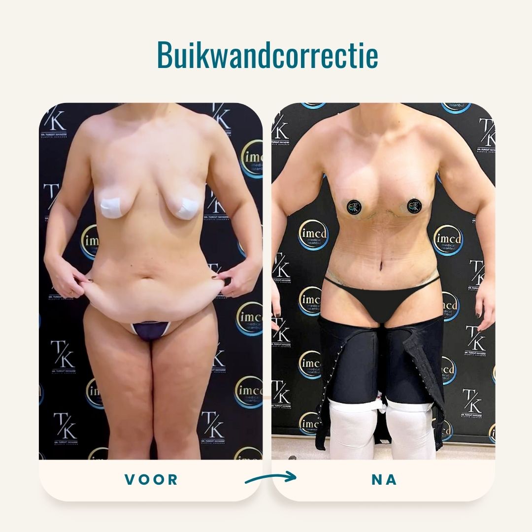 Buikwandcorrectie voor-na foto's-1