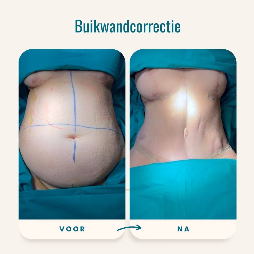 Buikwandcorrectie voor-na foto's-2