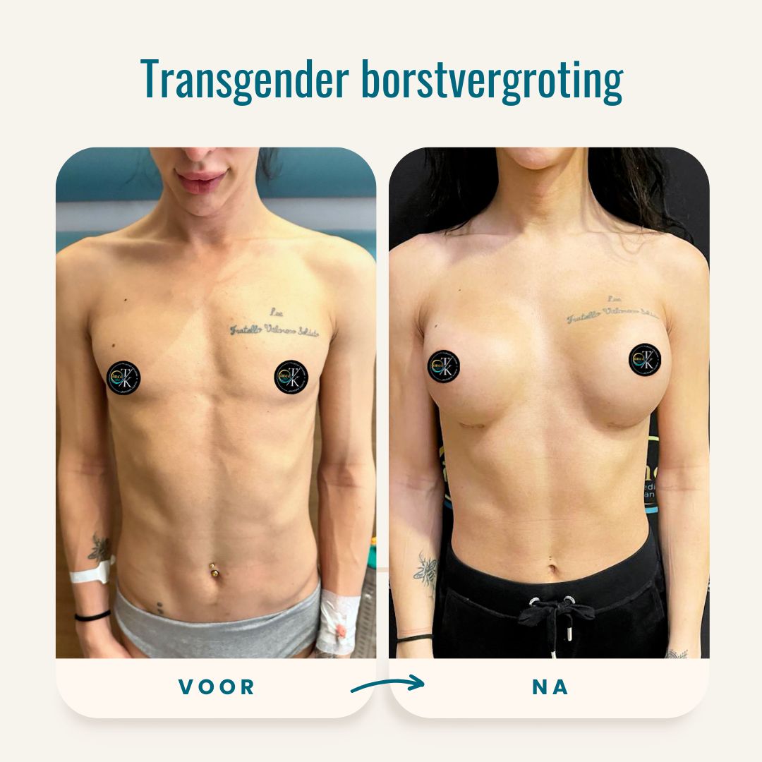 Transgender borstvergroting voor-na foto's-1