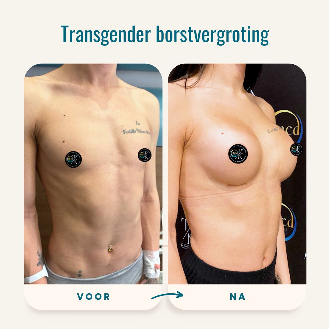 Transgender borstvergroting voor-na foto's-2