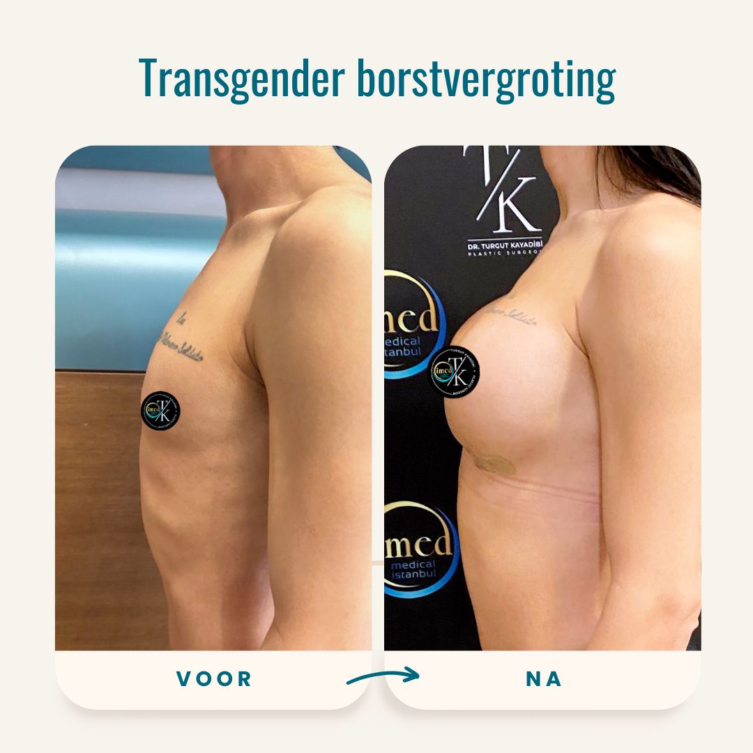 Transgender borstvergroting voor-na foto's-3