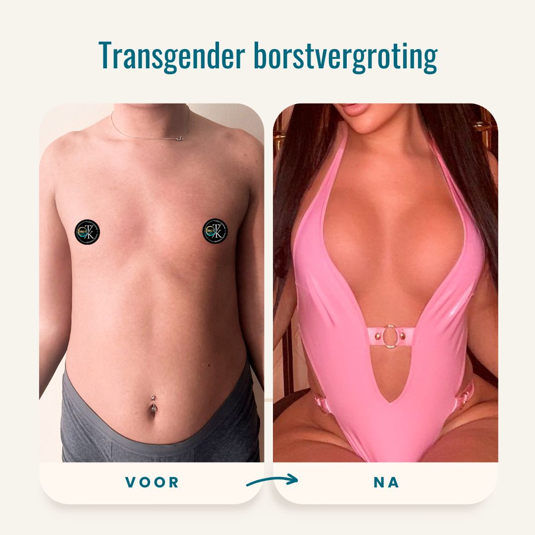 Transgender borstvergroting voor-na foto's-4