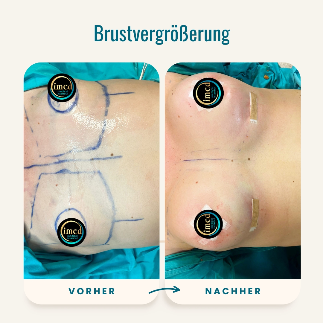 Vorher-nachher-Fotos der Brustvergrößerung-2