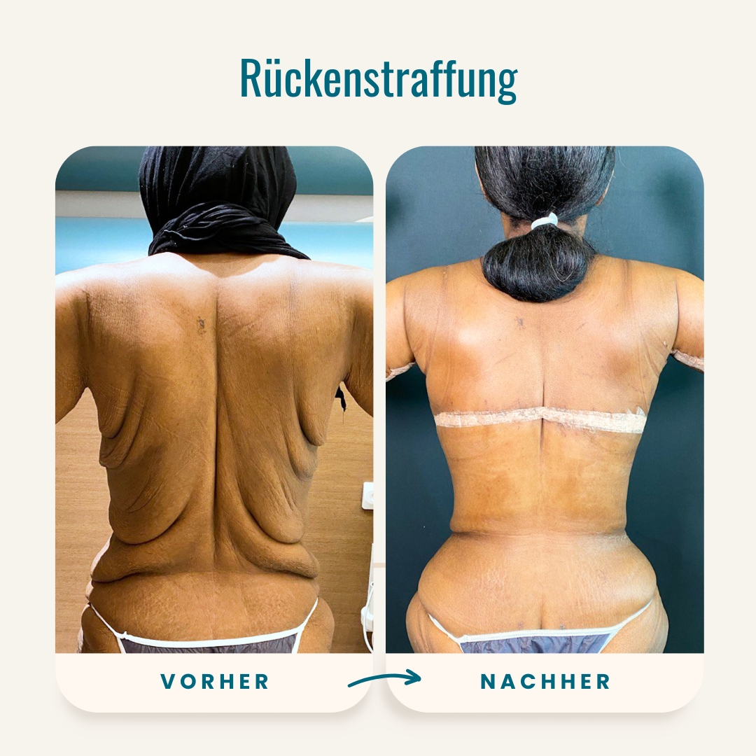 Vorher-nachher-Fotos der Rückenstraffung-1