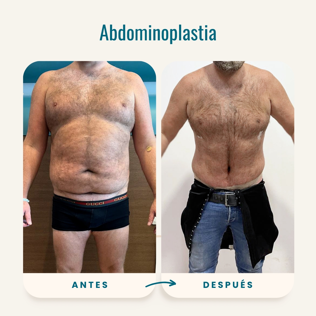 Fotos de antes y después de abdominoplastia-3