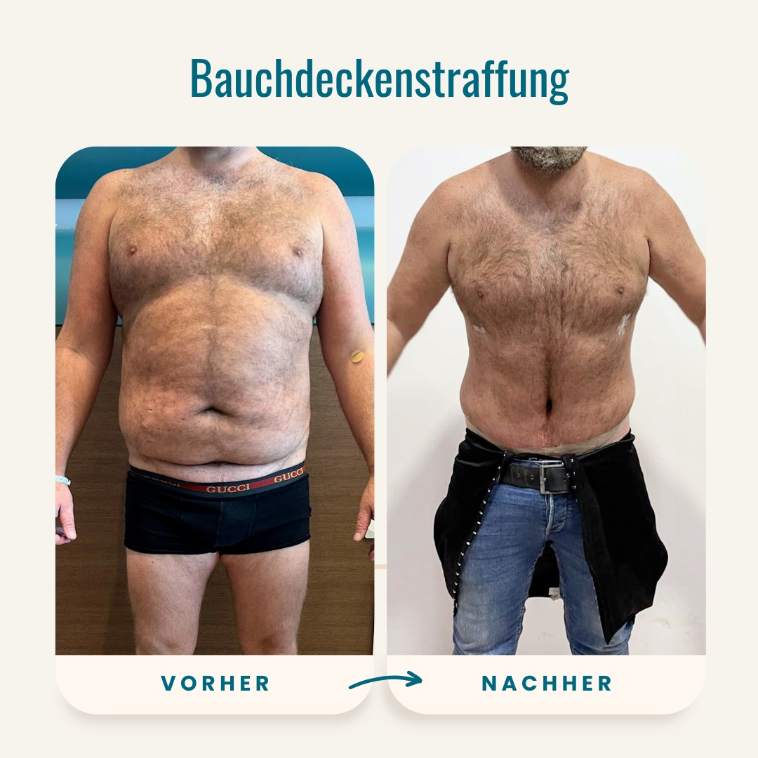 Vorher-nachher-Fotos der Bauchdeckenstraffung-3