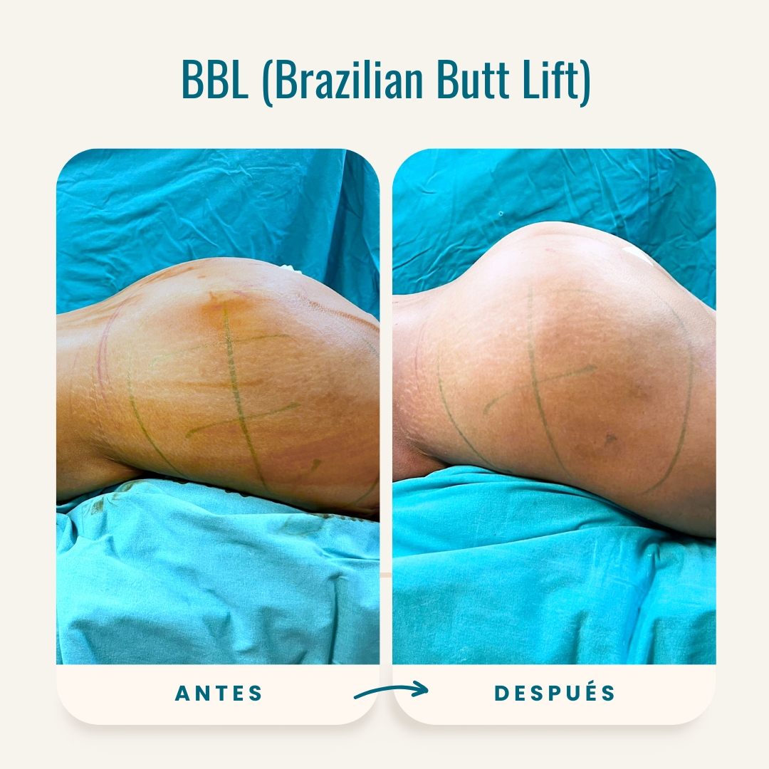 Fotos de antes y después de BBL (Brazilian Butt Lift)-1