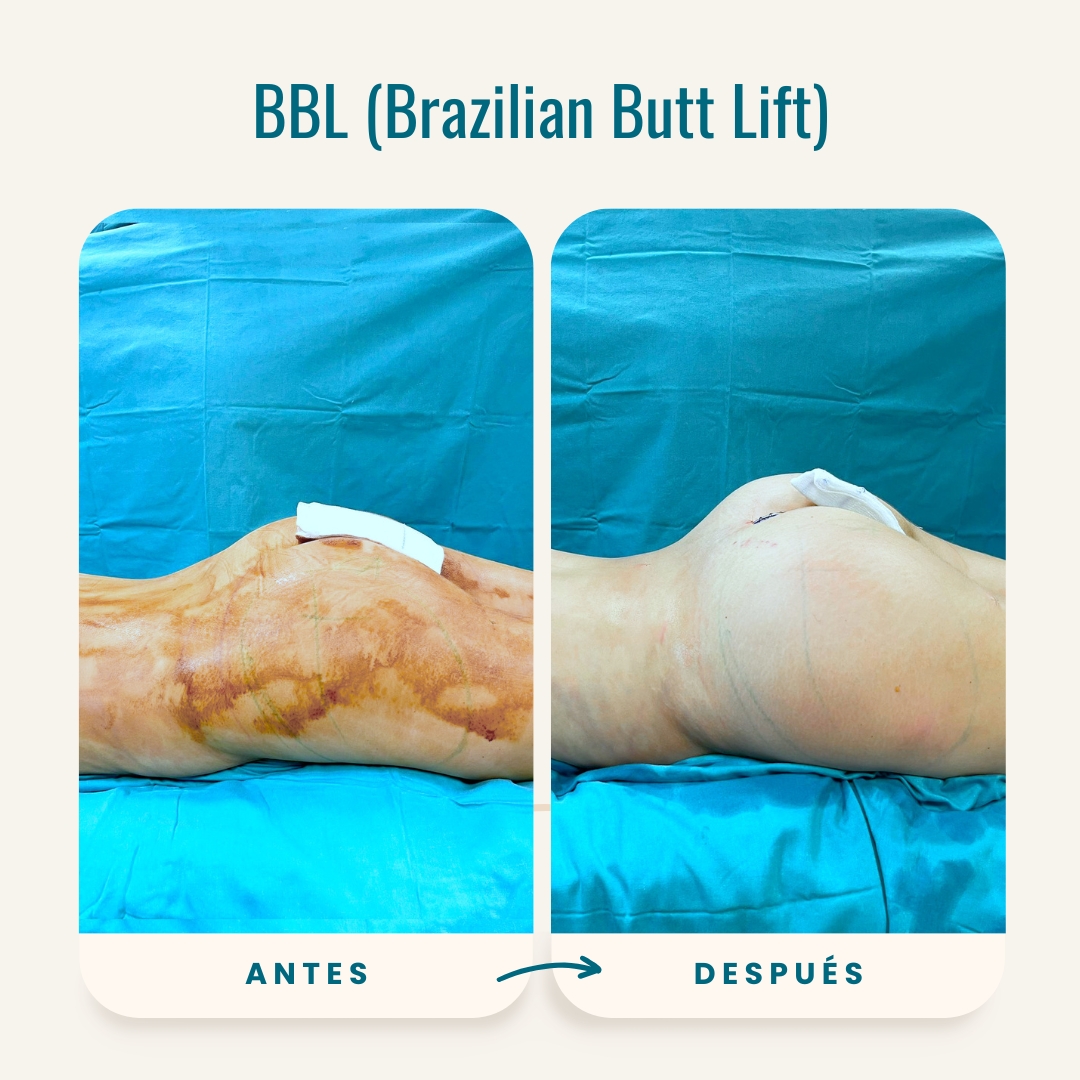 Fotos de antes y después de BBL (Brazilian Butt Lift)-3