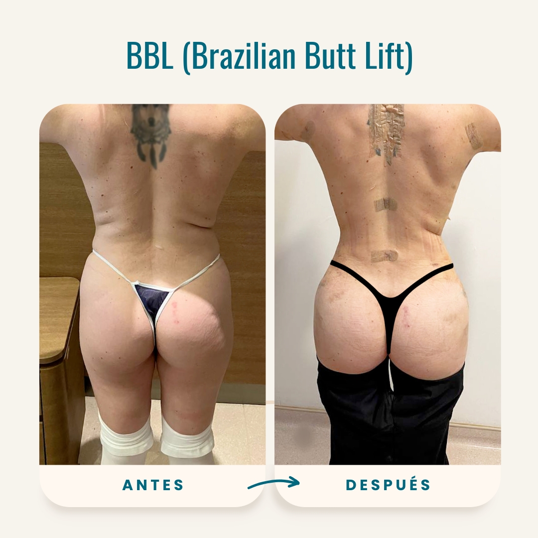 Fotos de antes y después de BBL (Brazilian Butt Lift)-4