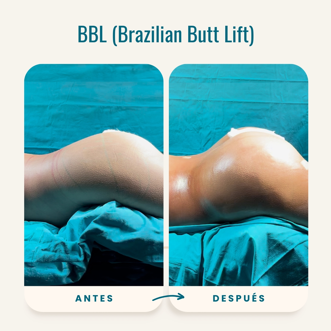 Fotos de antes y después de BBL (Brazilian Butt Lift)-5