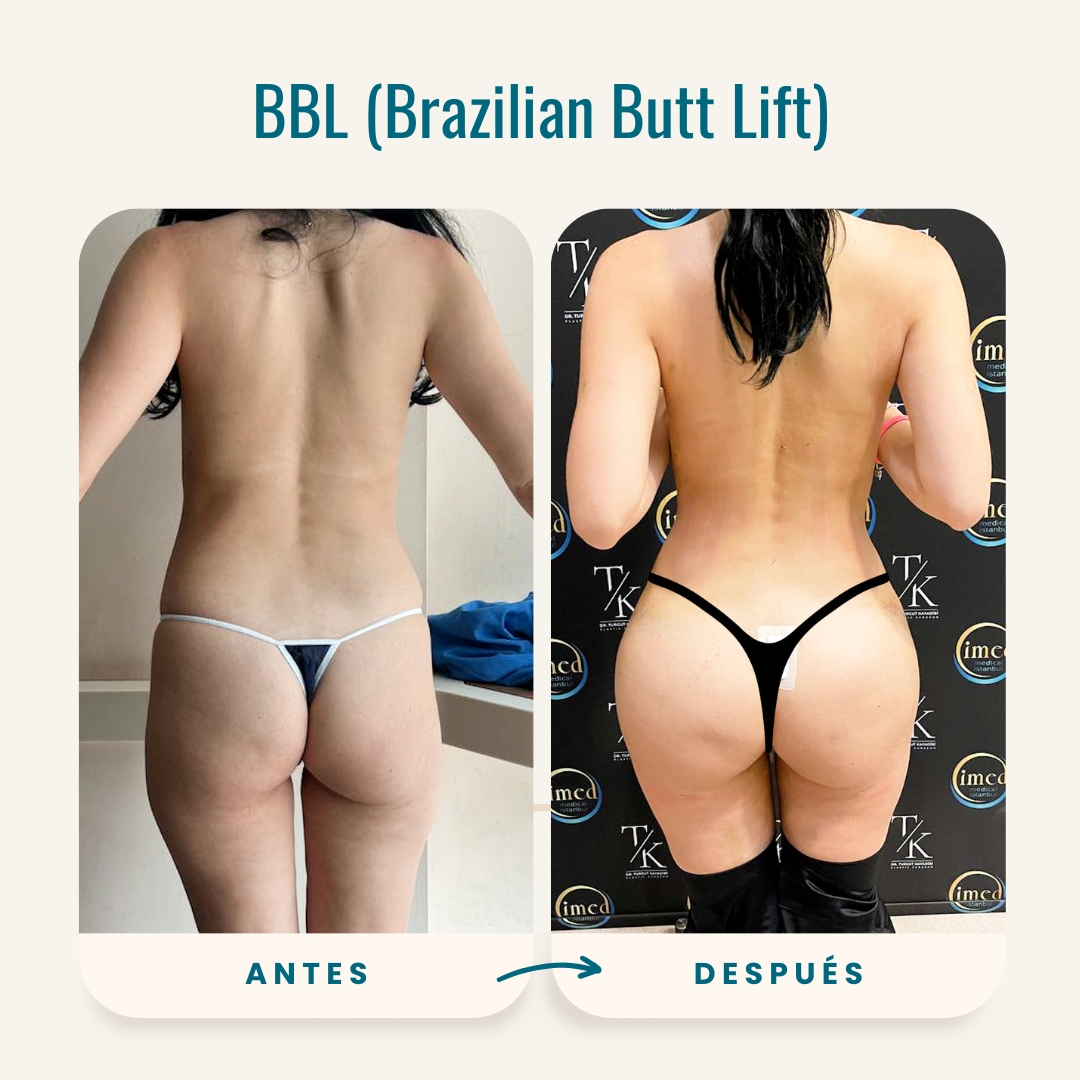 Fotos de antes y después de BBL (Brazilian Butt Lift)-6