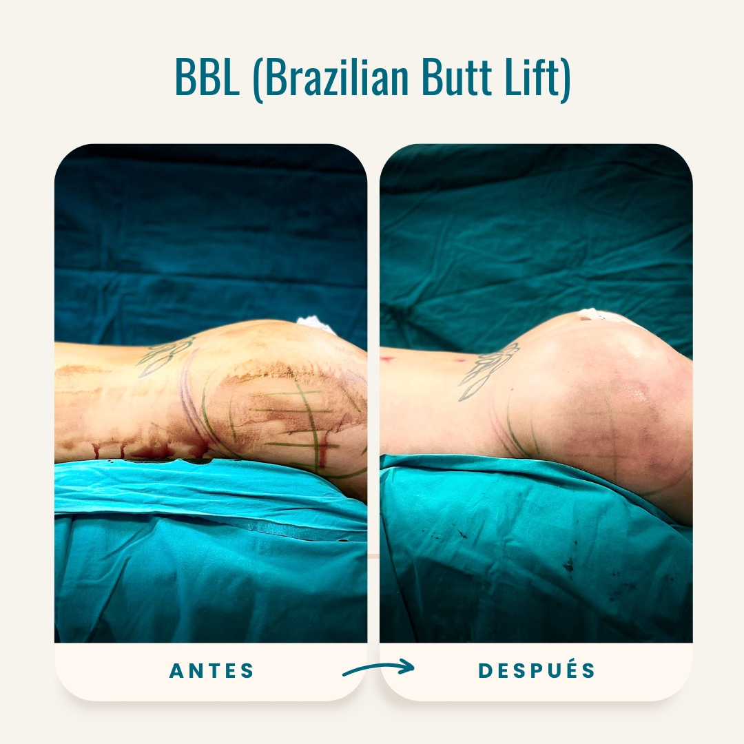 Fotos de antes y después de BBL (Brazilian Butt Lift)-7