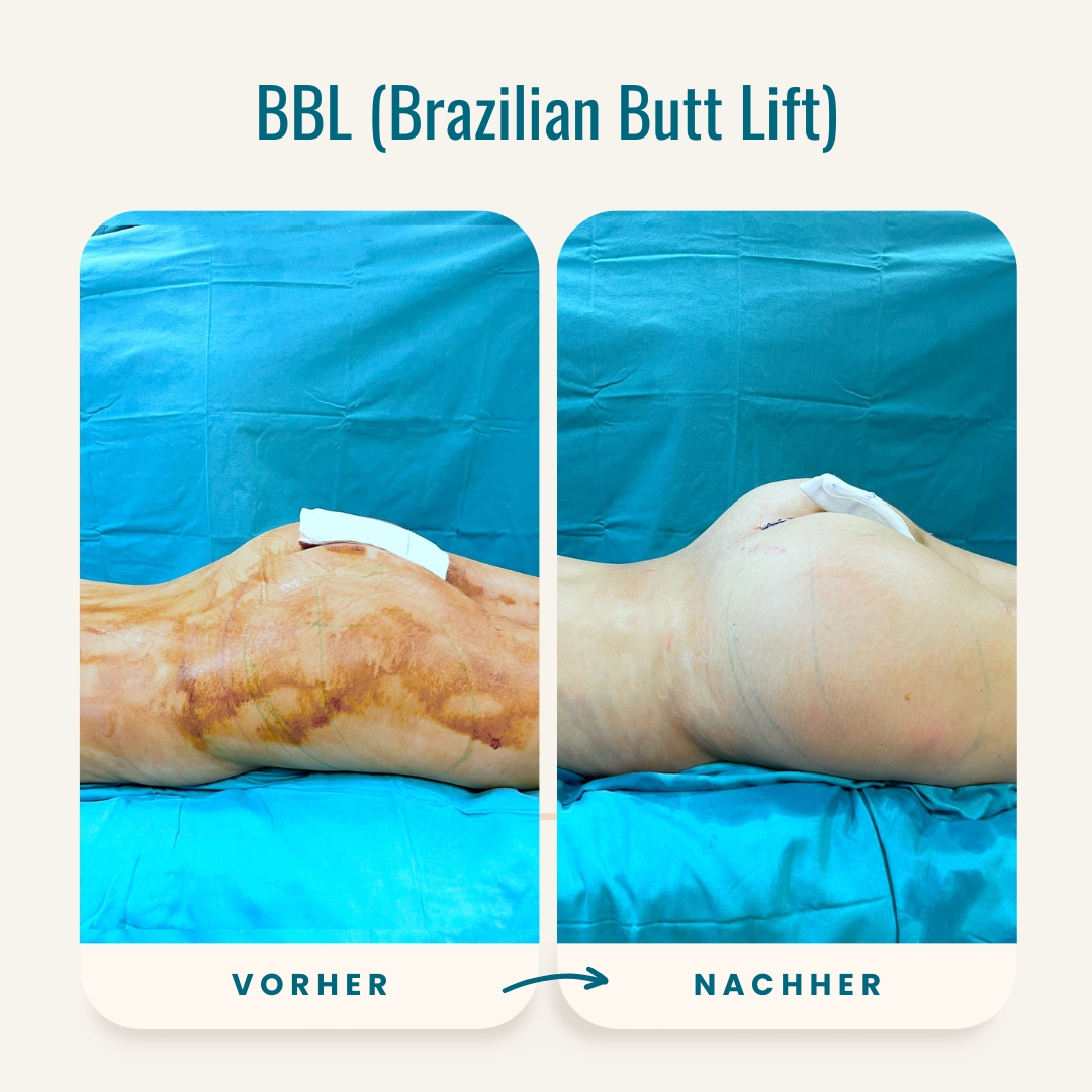 Vorher-nachher-Fotos des Brazilian Butt Lift-3