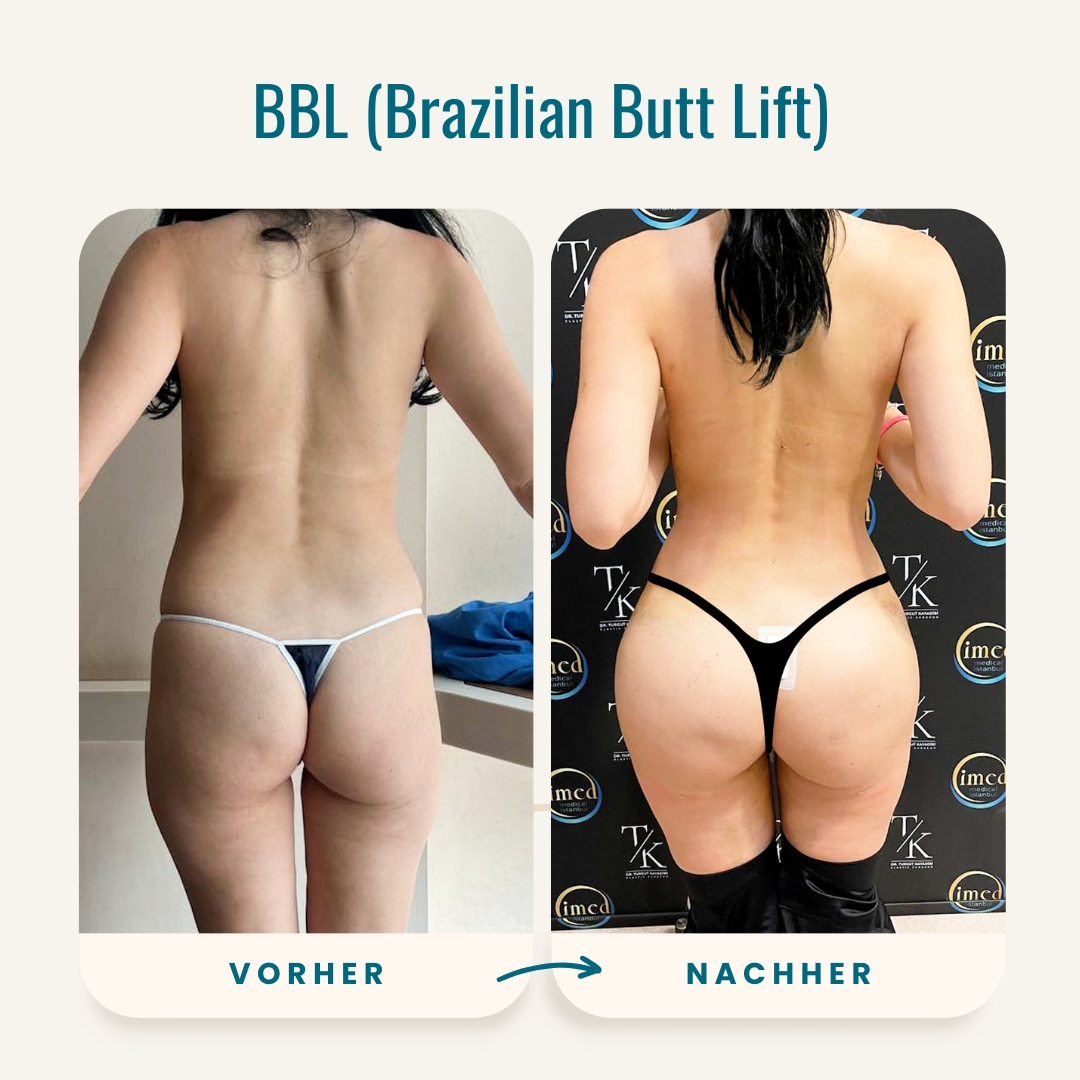 Vorher-nachher-Fotos des Brazilian Butt Lift-6