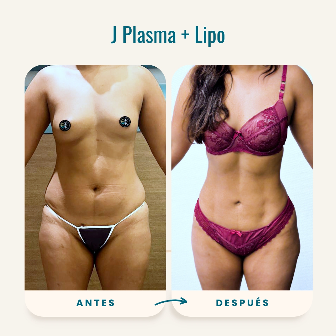 Fotos de antes y después de J Plasma + Lipo-2