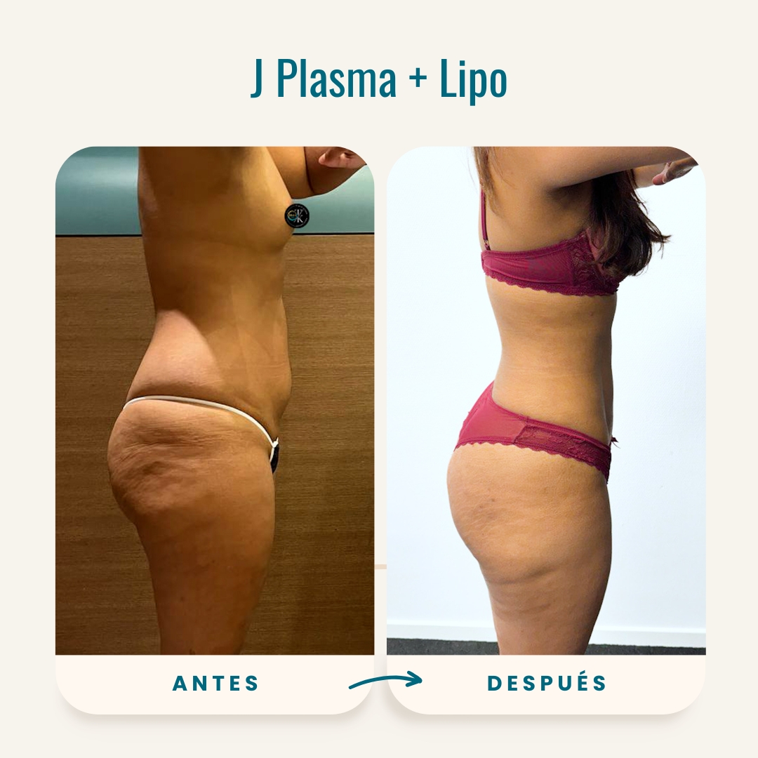 Fotos de antes y después de J Plasma + Lipo-3