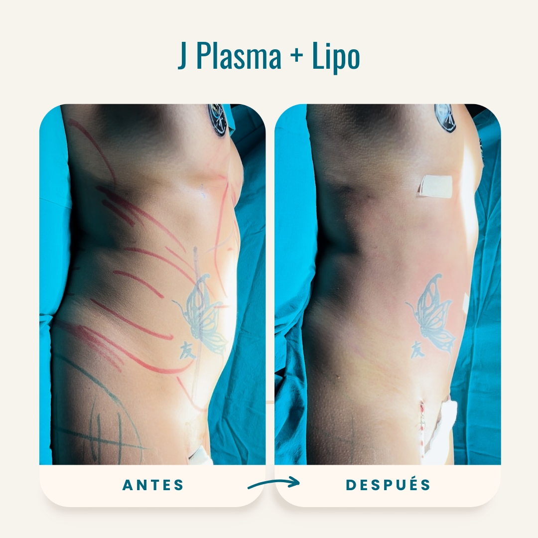 Fotos de antes y después de J Plasma + Lipo-4