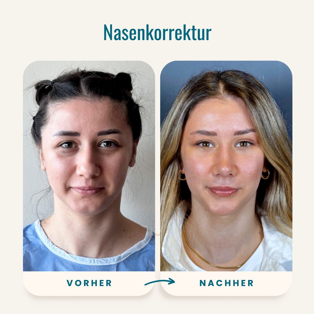 Vorher-nachher-Fotos der Nasenkorrektur-1