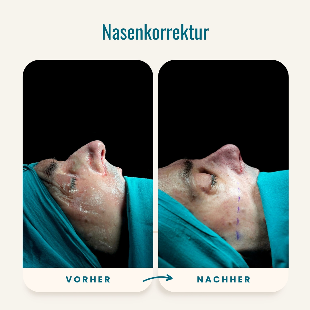 Vorher-nachher-Fotos der Nasenkorrektur-3