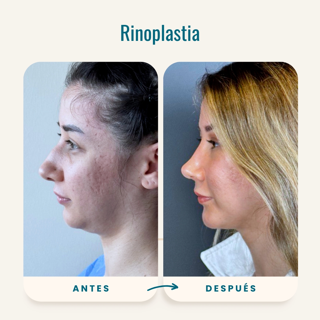 Fotos de antes y después de rinoplastia (cirugía de nariz)-2